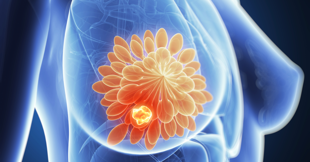 FDA aprueba talazoparib en cáncer de mama avanzado HER2 negativo BRCA m
