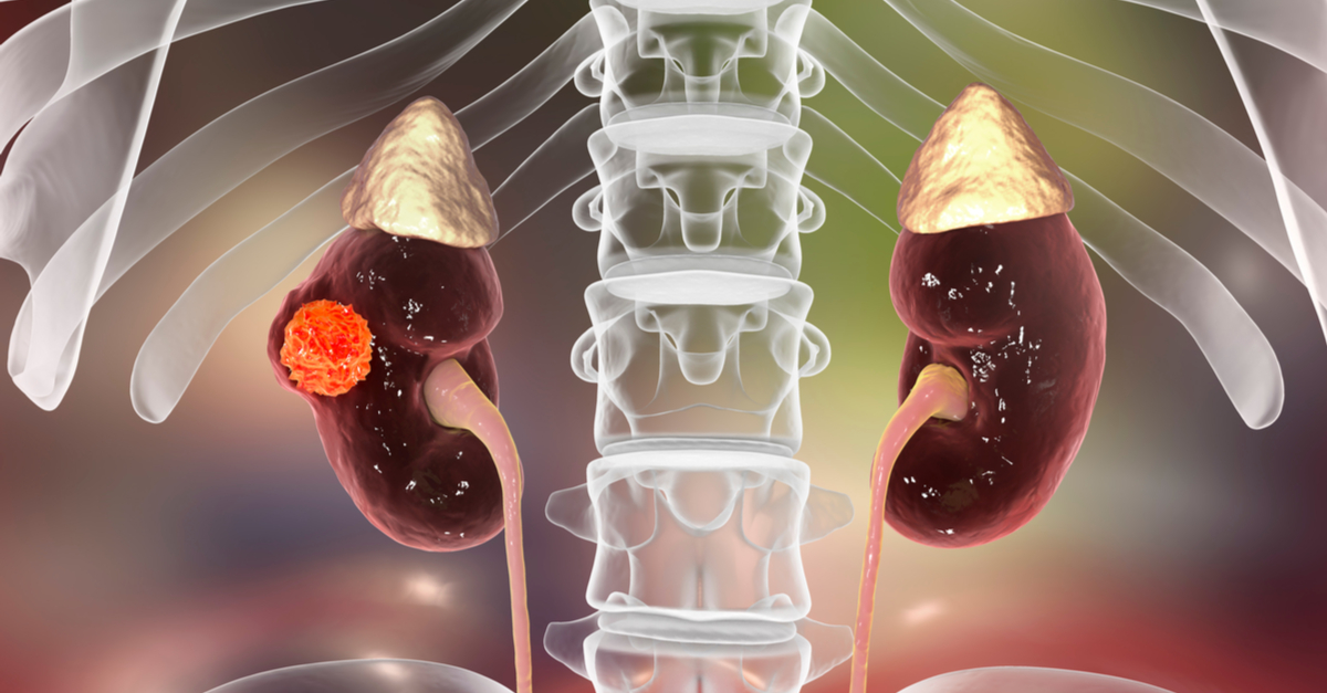 Tivozanib incrementa la SLP en comparación con sorafenib en pacientes con cáncer renal avanzado  altamente refractario