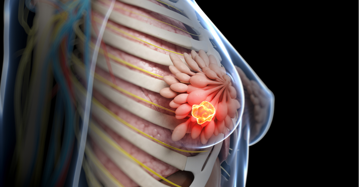 Abemaciclib efectivo en todos los subgrupos de pacientes con cáncer de mama HR+ HER 2-