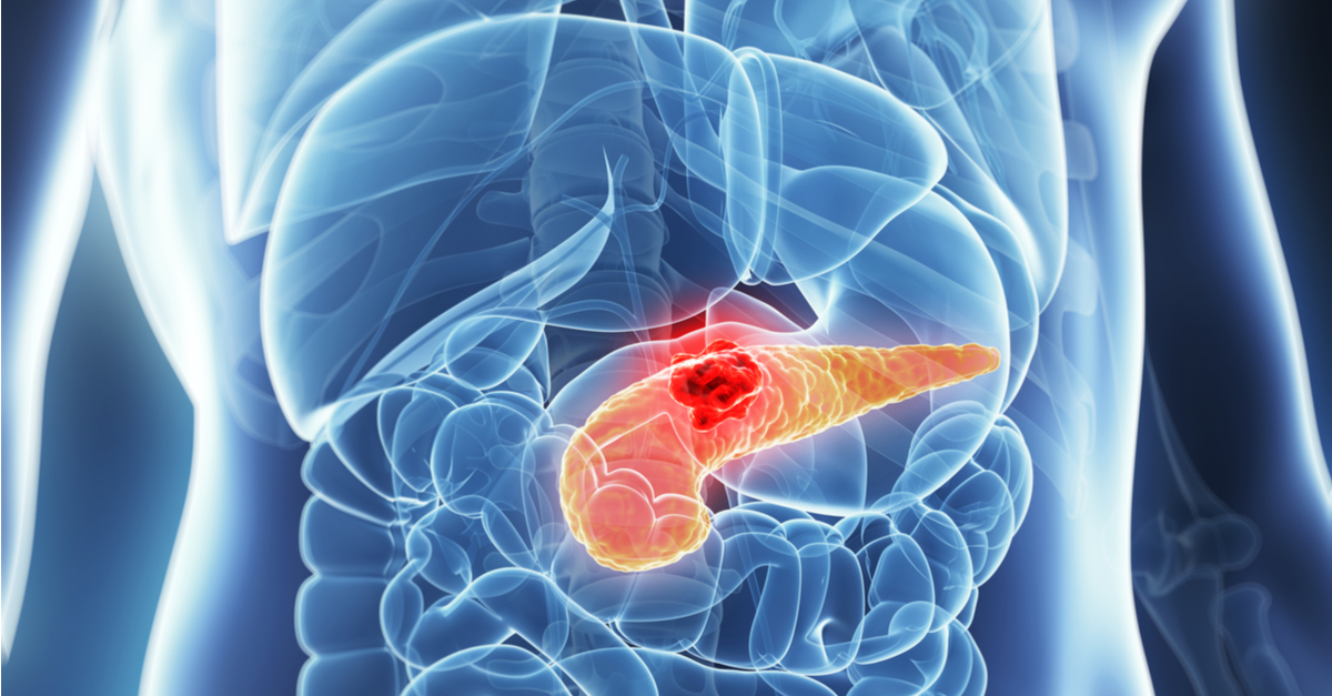 Estudio RESOLVE: Resultados de ibrutinib más nab-paclitaxel y gemcitabine en cáncer de páncreas avanzado