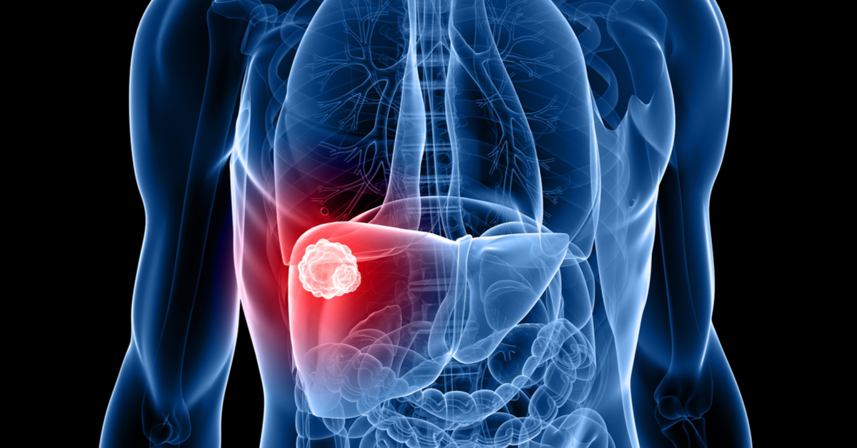 Pembrolizumab no demostró beneficio en SG y SLP en carcinoma hepatocelular avanzado en estudio fase III