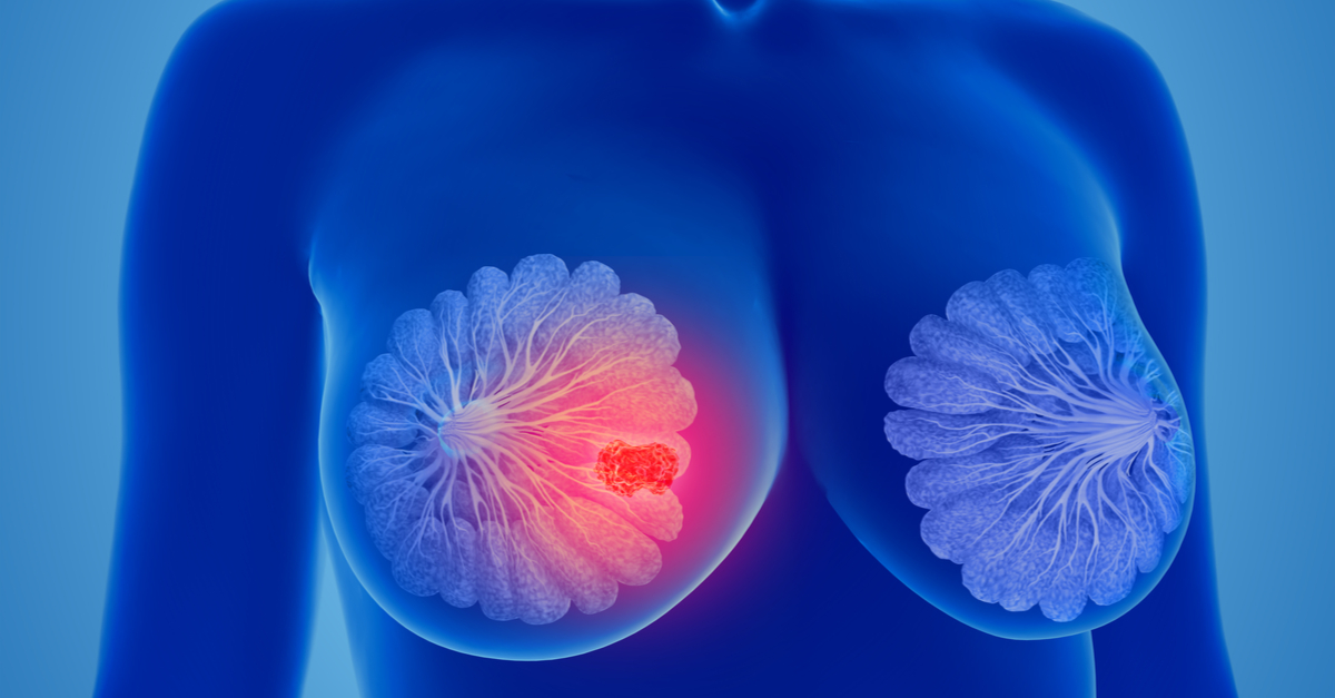 Margetuximab mejoró la SLP vs trastuzumab en cáncer de mama metastásico HER2 +