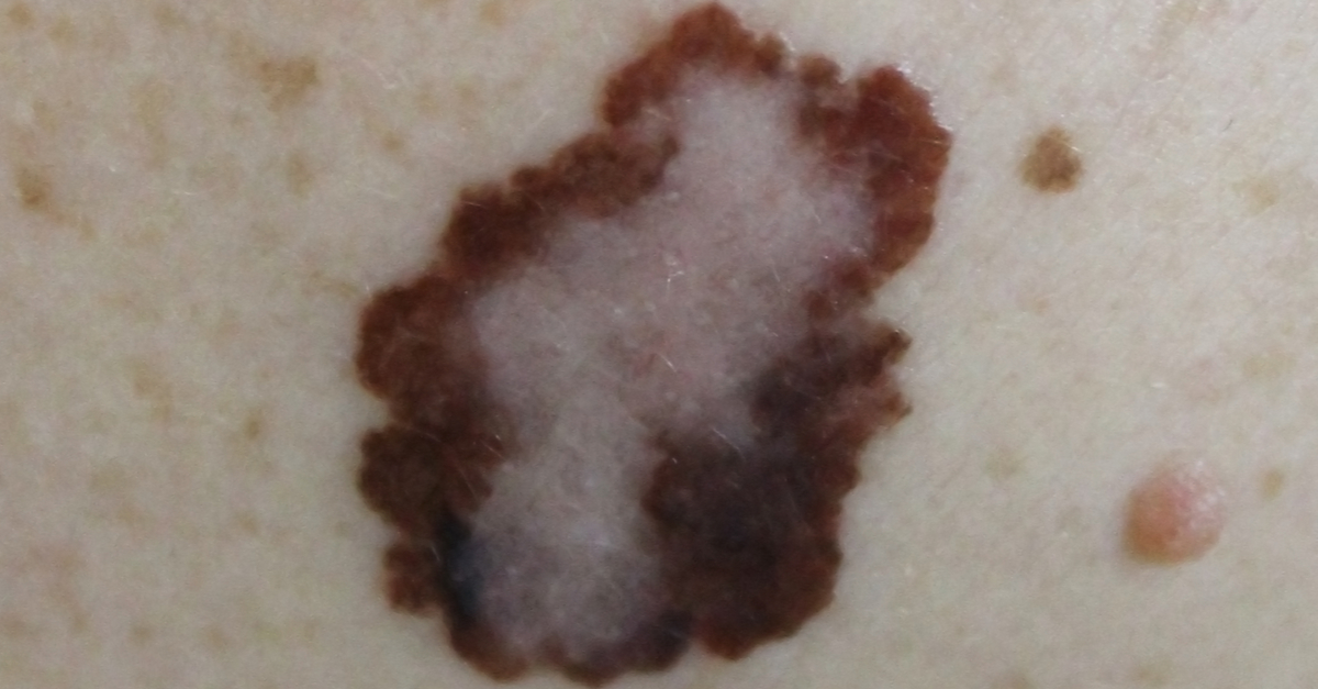 FDA aprueba pembrolizumab adyuvante en melanoma estadio III con afectación en ganglios linfáticos después de resección completa