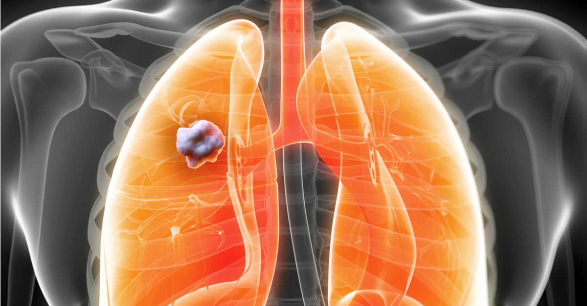 Osimertinib incrementa significativamente la SG en 1L de CPCNP EGFR+