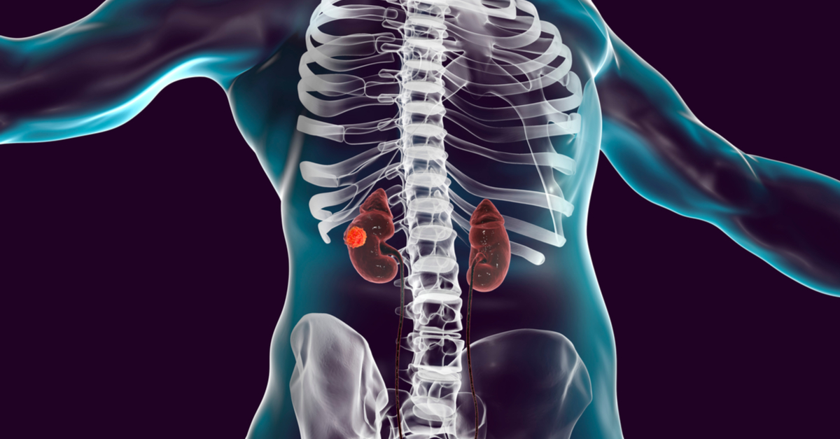 Pembrolizumab más axitinib extienden la SG y la SLP vs estándar actual en cáncer renal avanzado