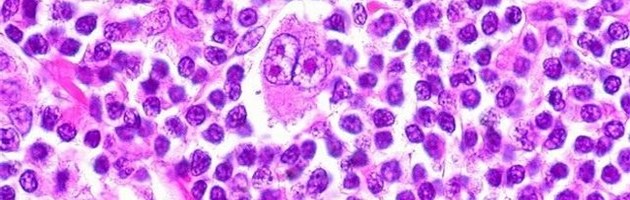 Pembrolizumab incrementa la SLP vs. brentuximab vedotin en linfoma de Hodgkin clásico refractario