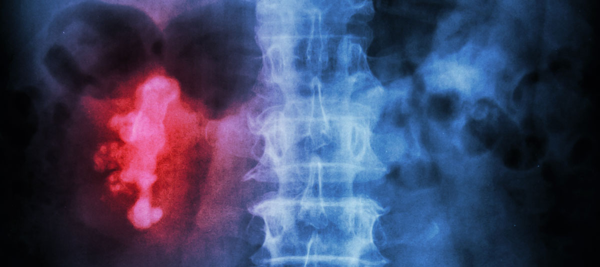 Cáncer renal avanzado sin tratamiento previo: Nivolumab + cabozantinib incrementan SLP, SG y ORR