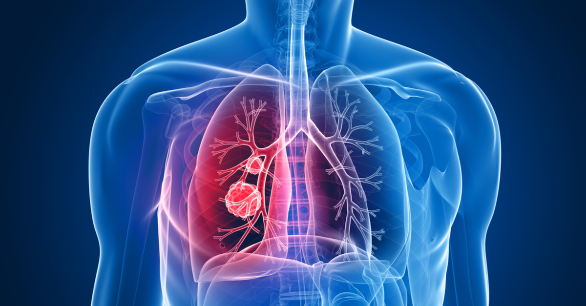 FDA aprueba brigatinib en 1L de CPCNP ALK+