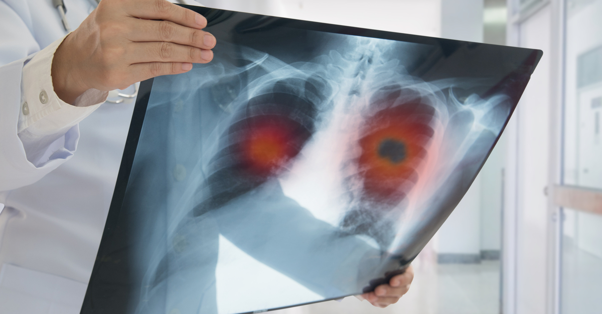 Nivolumab más ipilimumab incrementan la SG en mesotelioma pleural maligno irresecable