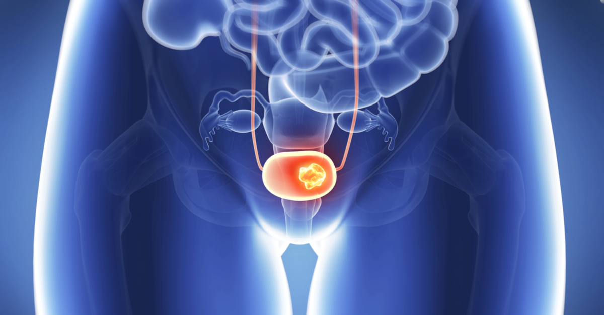 Enfortumab vedotin-ejfv mejoró significativamente la SG en fase III de cáncer urotelial avanzado