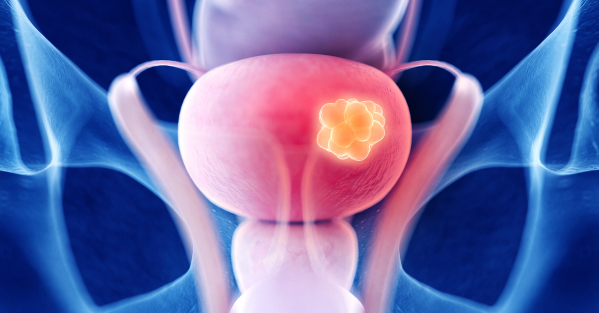 Nivolumab incrementa la SLE vs. placebo como terapia adyuvante en carcinoma urotelial con invasión muscular de alto riesgo