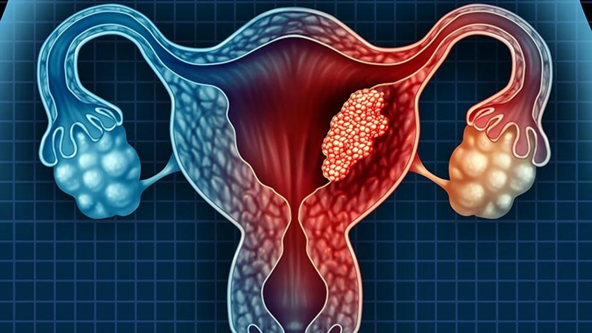 KEYNOTE-775/Estudio 309 posiciona a pembrolizumab + lenvatinib como un buen candidato para pacientes con cáncer de endometrio avanzado después de QT previa a base de platino