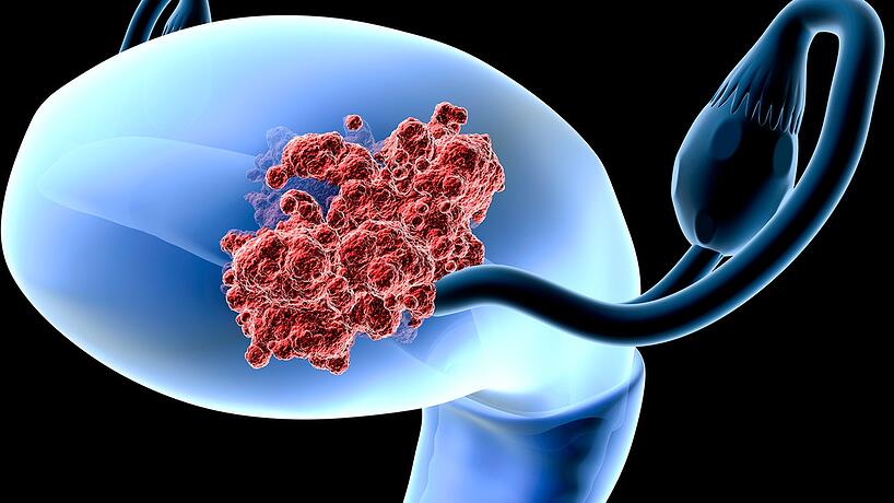 Estudio fase III de cemiplimab monoterapia en cáncer de cuello uterino avanzado se interrumpe tempranamente por resultados positivos de SG