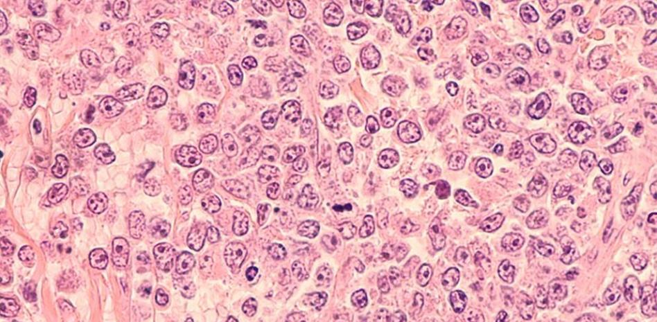 Copanlisib-rituximab reducen la progresión o muerte en pacientes con LNH indolente: CHRONOS-3