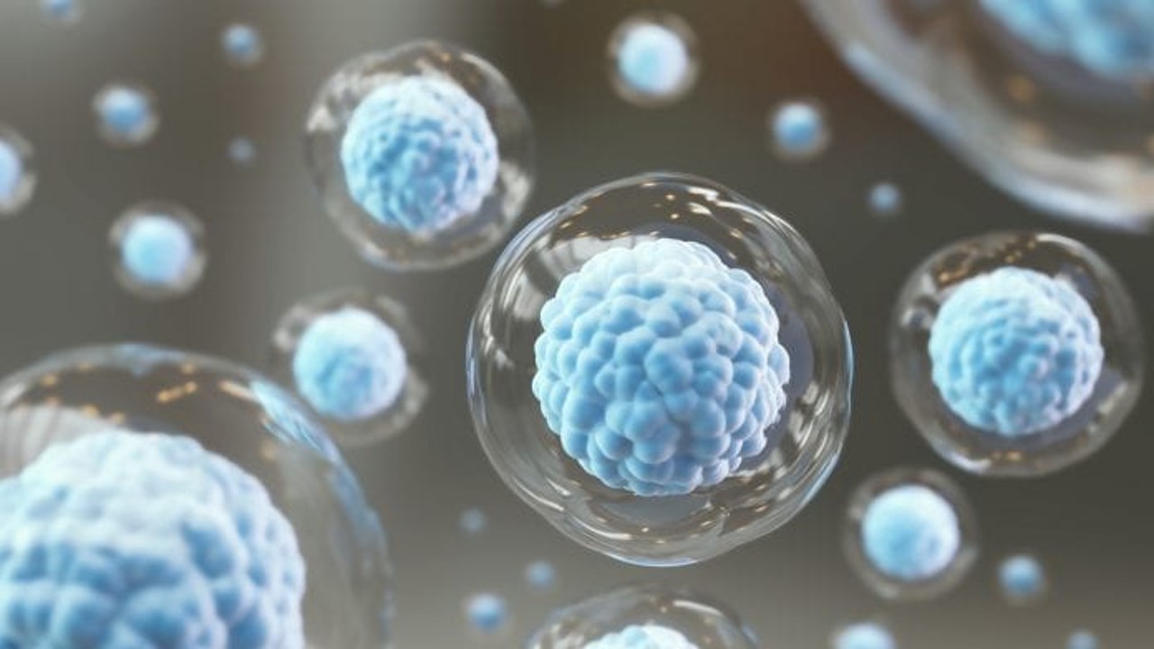 Linfoma B de células grandes en recaída o refractario: Axicabtagén ciloleucel mejoró la supervivencia sin eventos en segunda línea