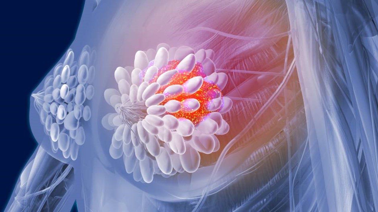 CMTN: FDA aprueba pembrolizumab + QT neoadyuvante en pacientes en estadio temprano de alto riesgo