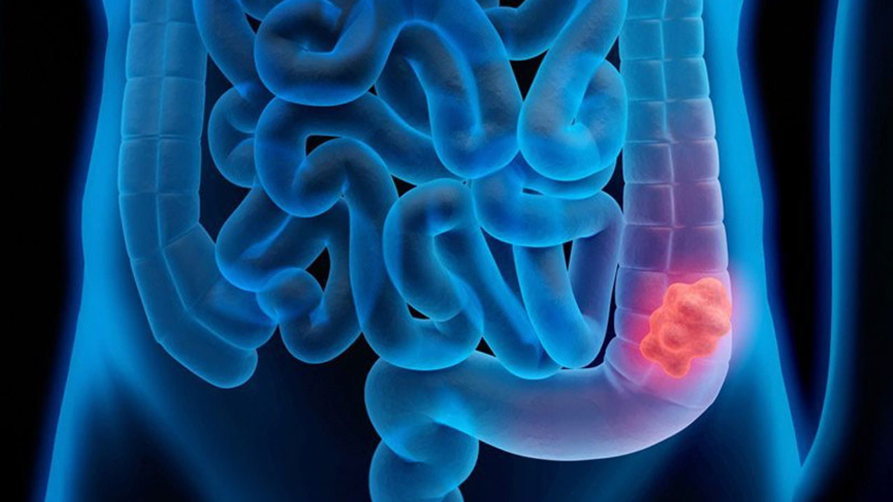 Cáncer colorrectal con mutación de KRAS G12C: Sotorasib en combo demuestra una eficacia y seguridad alentadoras