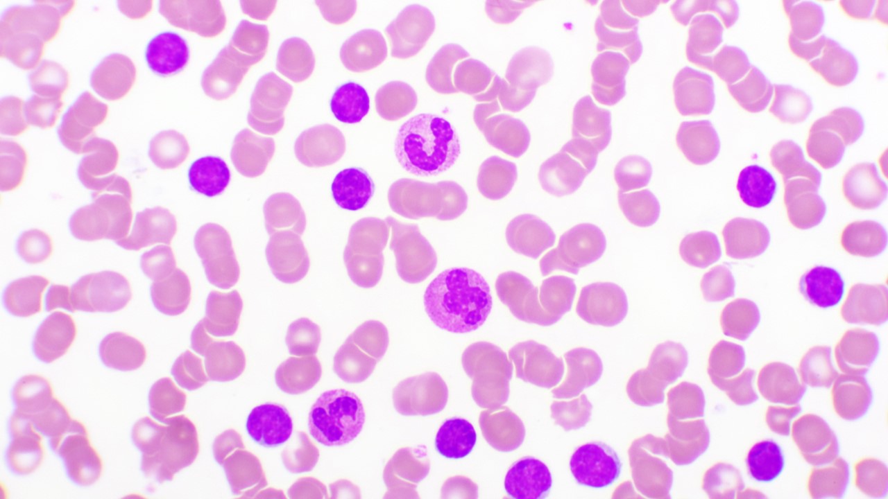 LLA de células B r/r: FDA aprueba brexucabtagene autoleucel, estudio ZUMA-3