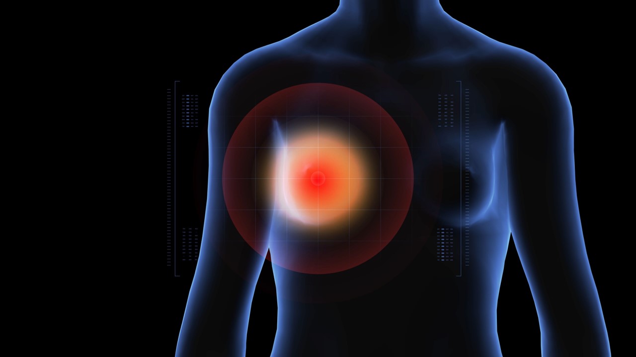 Cáncer de mama: Resultados positivos con elacestrant en pacientes RE+/HER2-, estudio EMERALD
