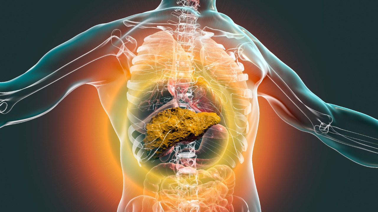 Carcinoma hepatocelular: Durvalumab + tremelimumab mejoran significativamente la SG, estudio HIMALAYA