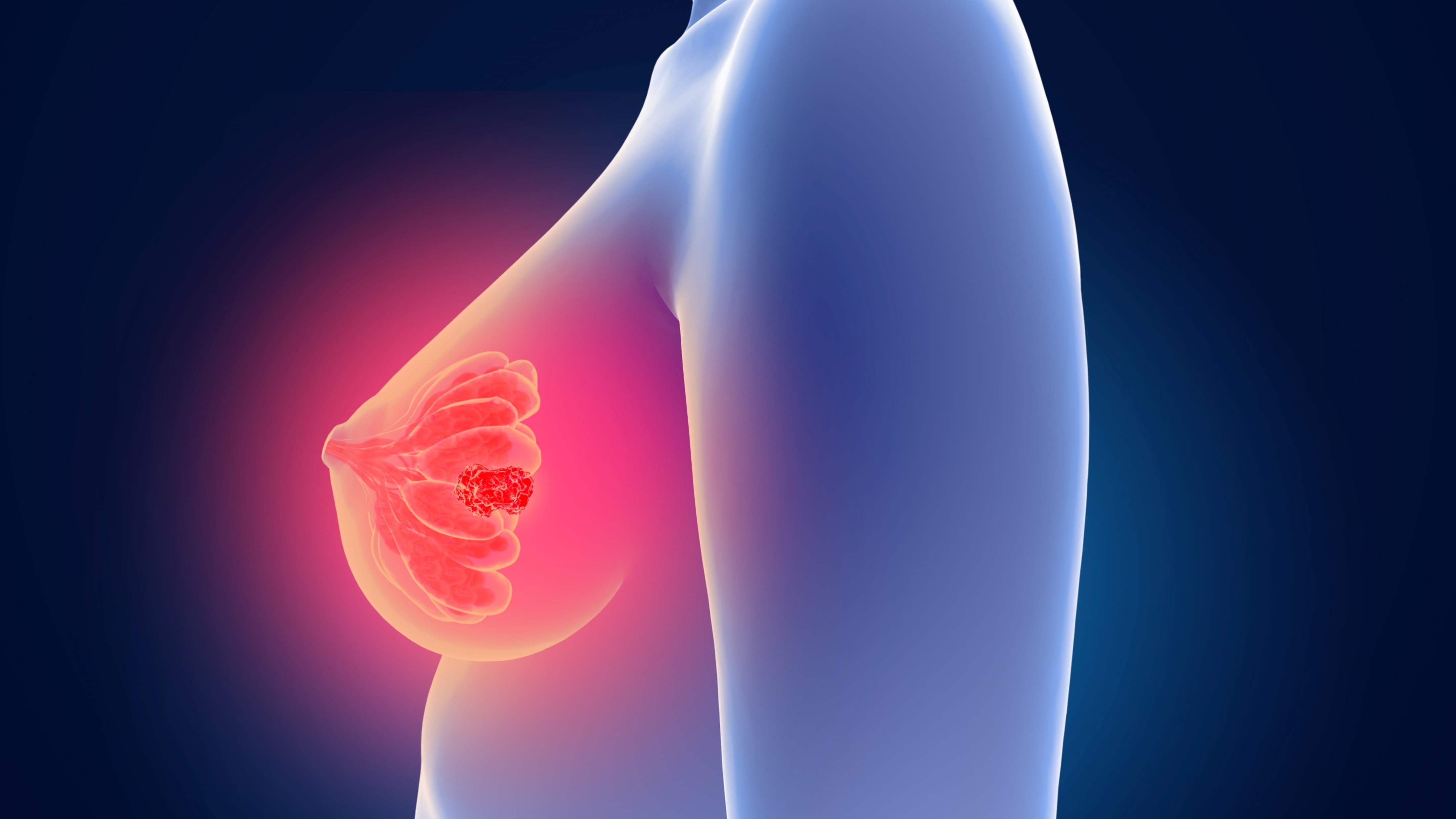 CMM HER2+: Trastuzumab deruxtecan en revisión prioritaria, estudio DESTINY-Breast03