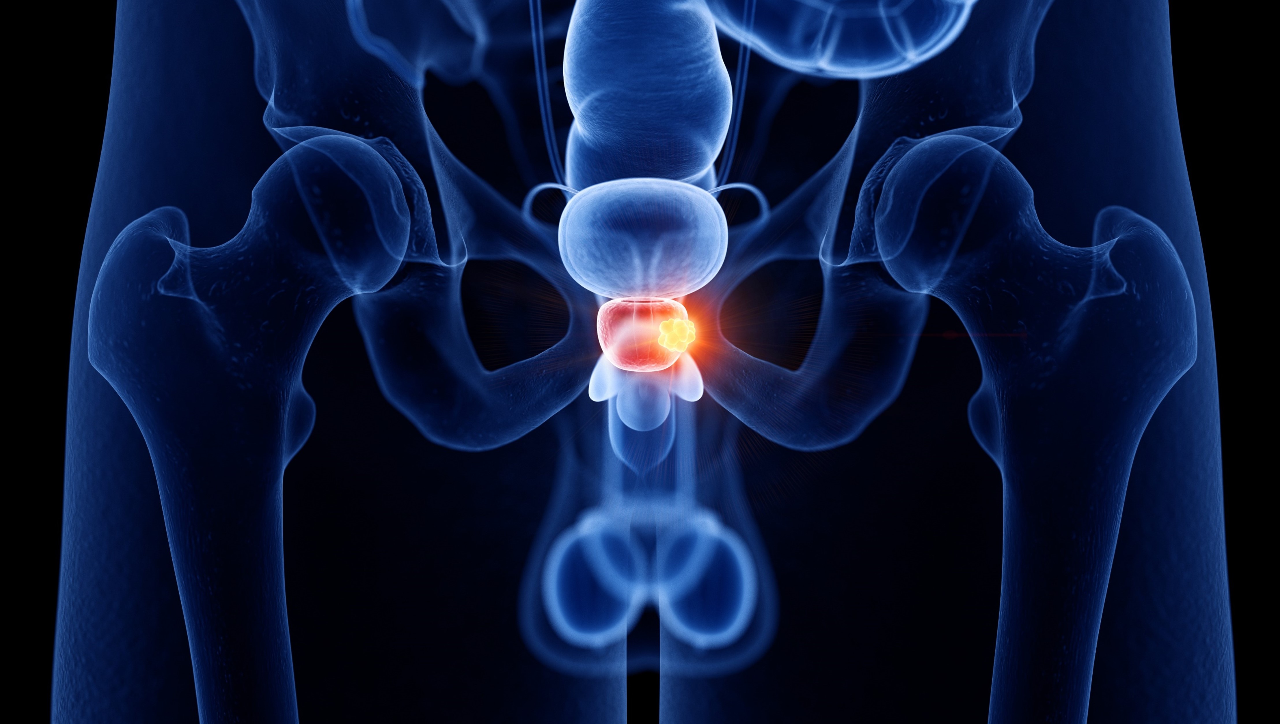 Cáncer de próstata: FDA concede aprobación a la prueba 4Kscore