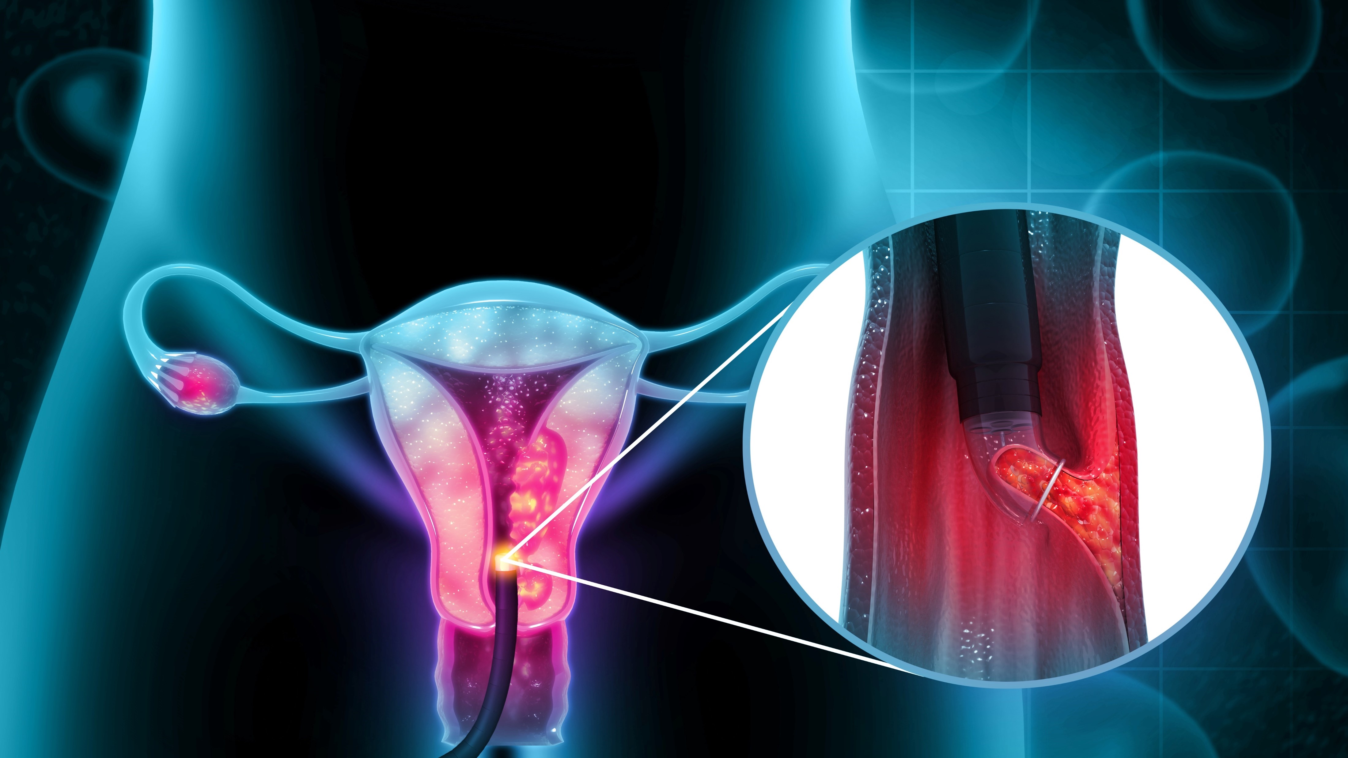 Ca. de endometrio avanzado: Pembrolizumab + lenvatinib demuestran mejoras significativas en SG y SLP vs. QT, KEYNOTE-775/Estudio 309
