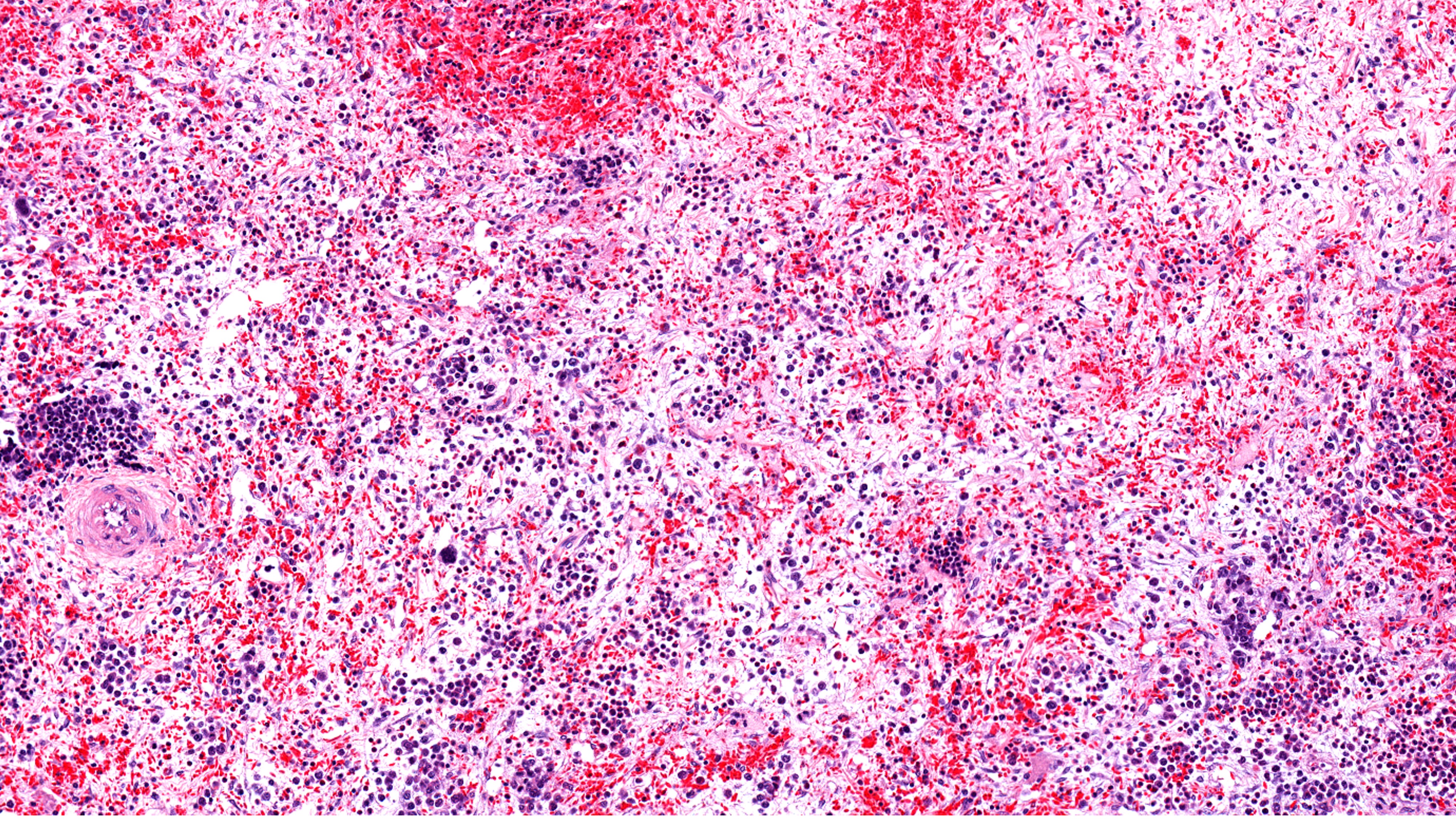 Mielofibrosis y trombocitopenia: FDA aprueba pacritinib, estudio PERSIST-2