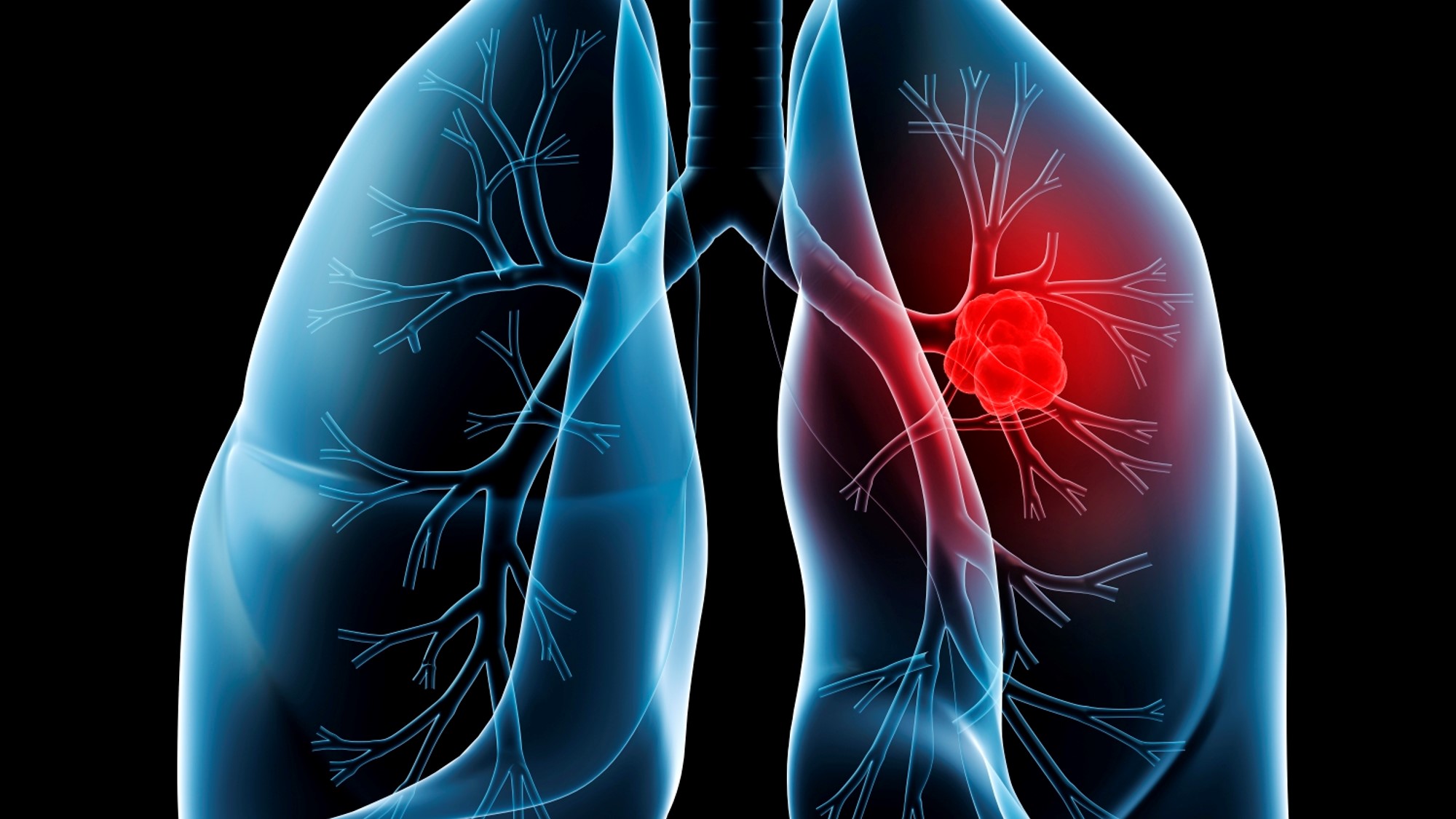 CPCNP: FDA aprueba nivolumab + QT doble con platino, CheckMate-816