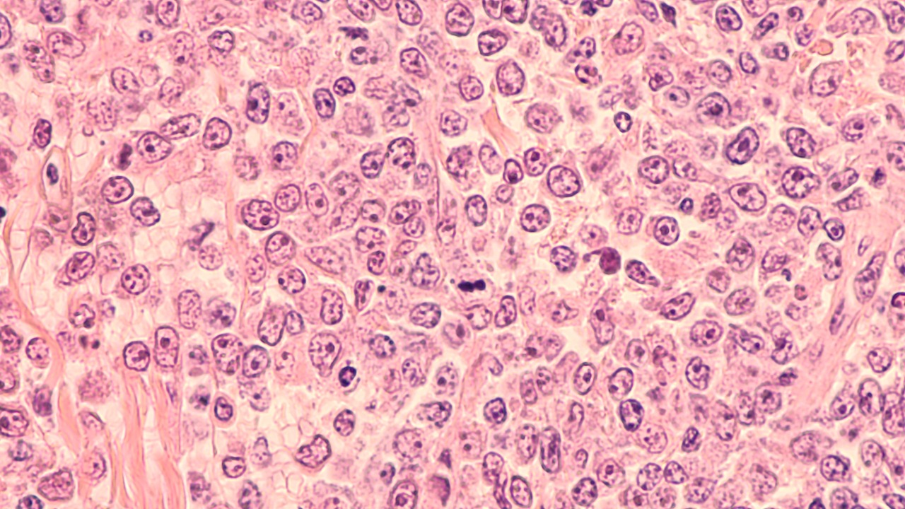Linfoma de células B grandes en R/R: La FDA otorgó revisión prioritaria para lisocabtagene maraleucel como terapia de 2L, estudio TRANSFORM