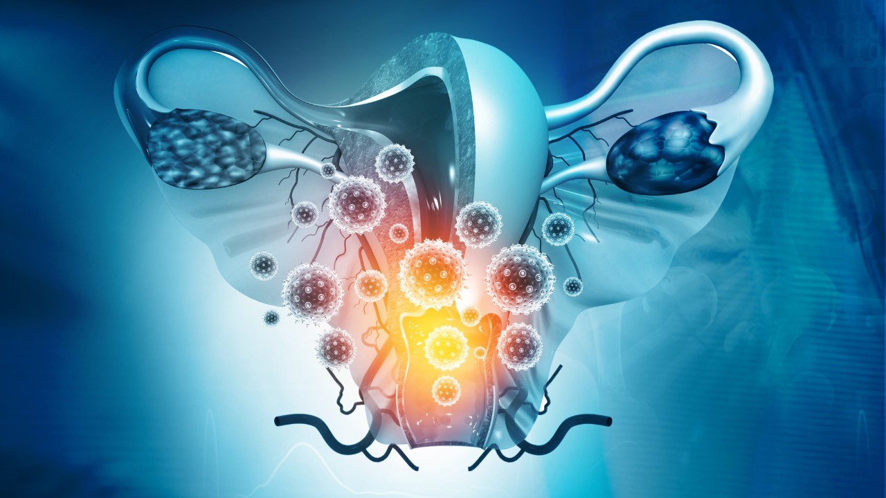 Ca. de cuello uterino localmente avanzado: Durvalumab con quimioterapia + radioterapia no cumplen su objetivo primario de SLP, estudio CALLA