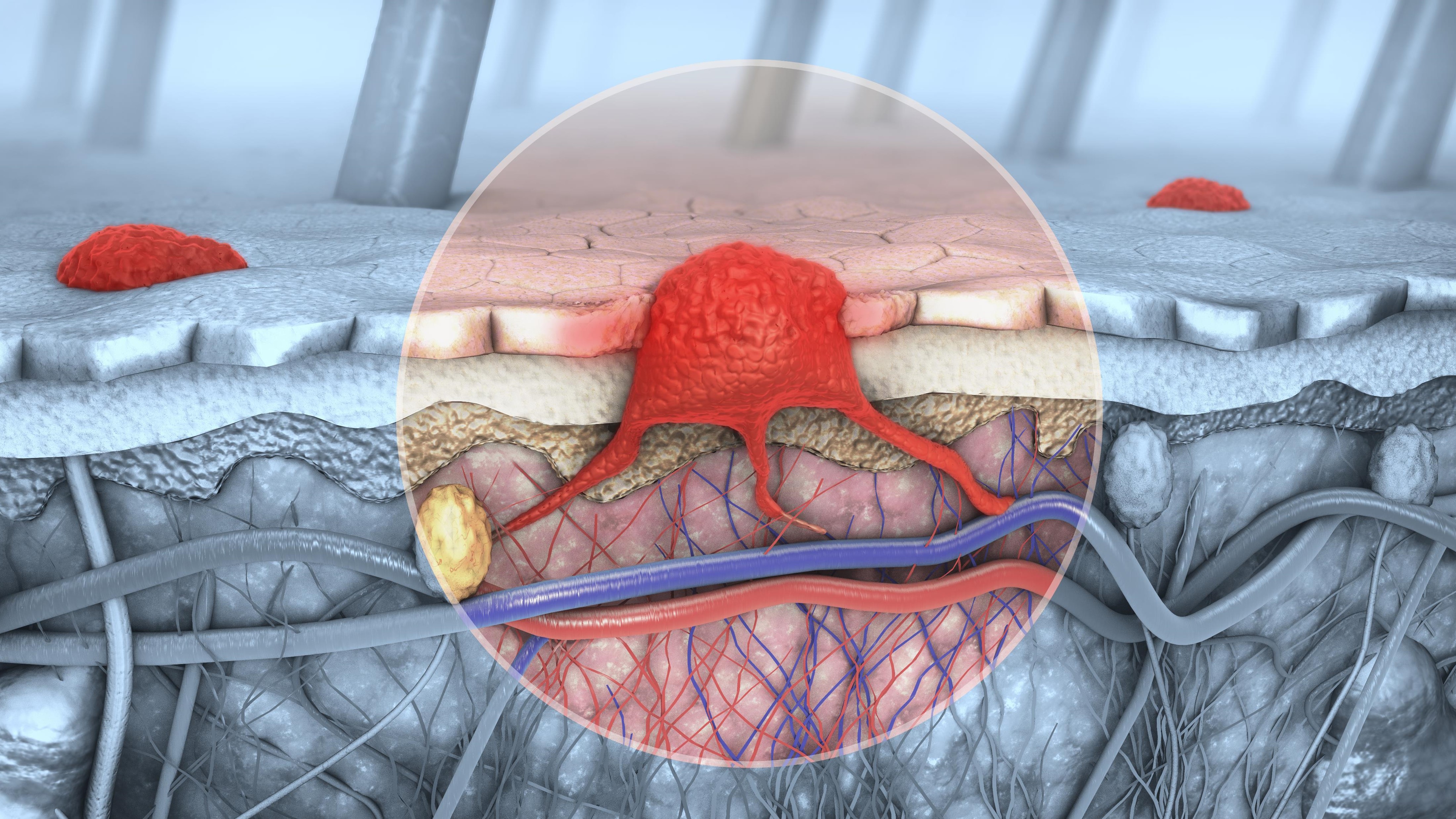Melanoma estadio IIb/IIc: Aprobación europea de pembrolizumab, estudio KEYNOTE-716
