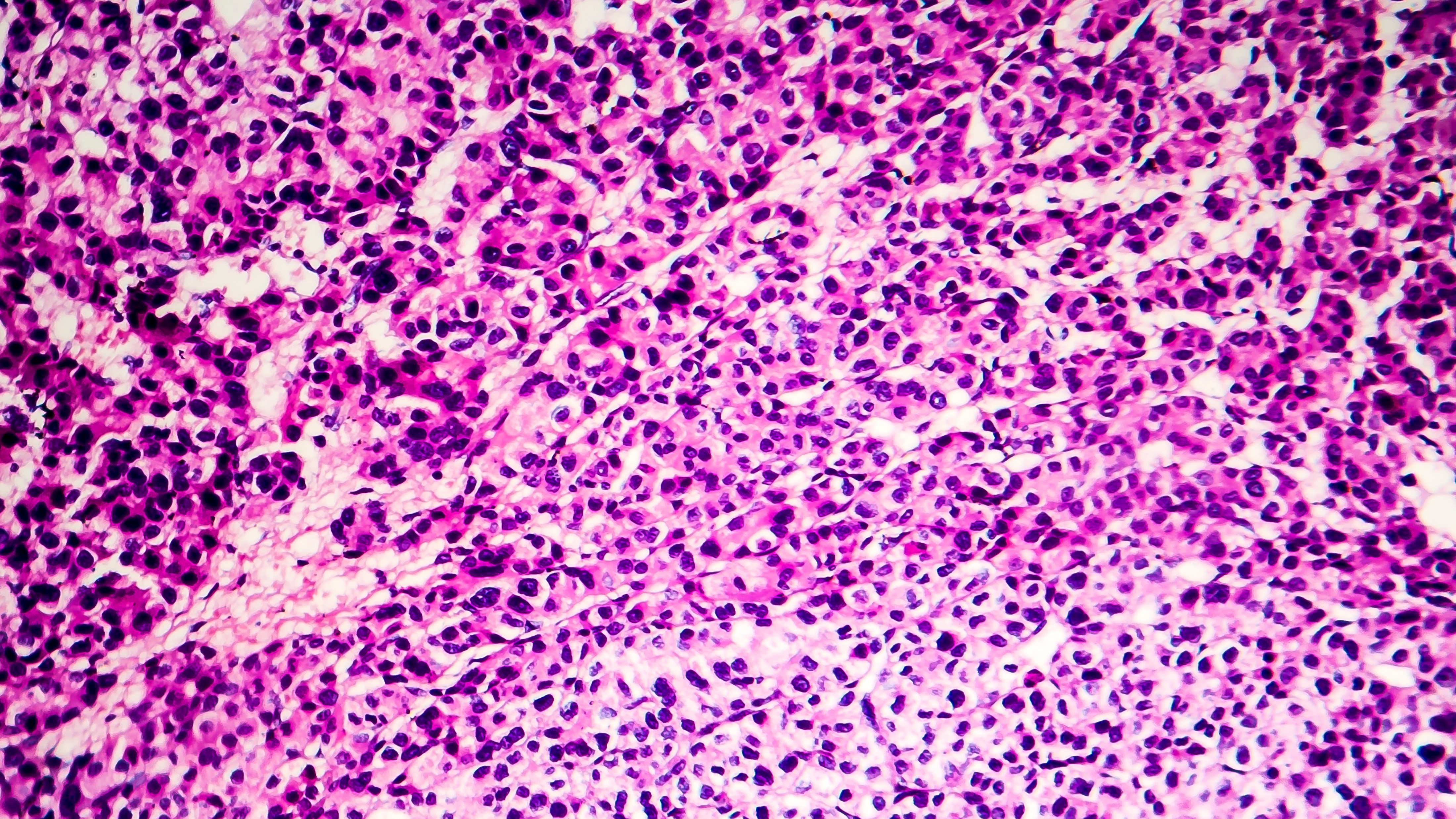 HCC irresecable: La BLA para tremelimumab fue aceptada para revisión prioritaria, estudio HIMALAYA