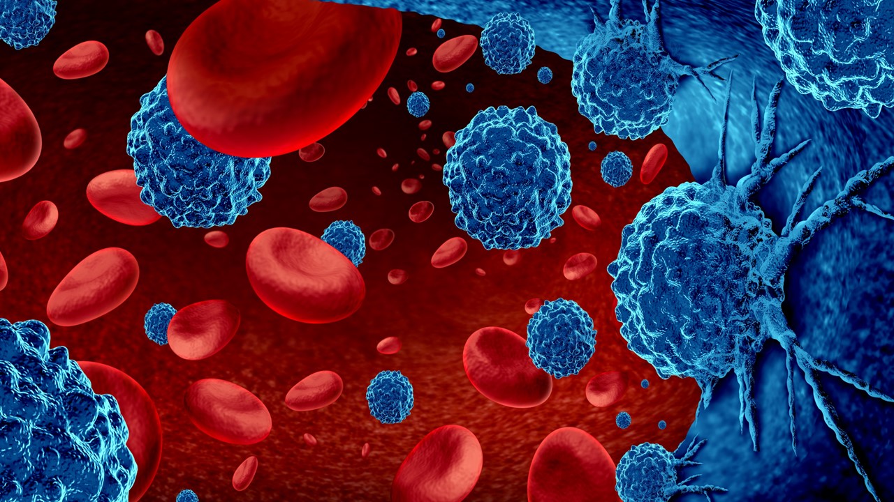 Linfoma de Hodgkin avanzado: Brentuximab vedotin + QT mejoran SG, estudio ECHELON-1