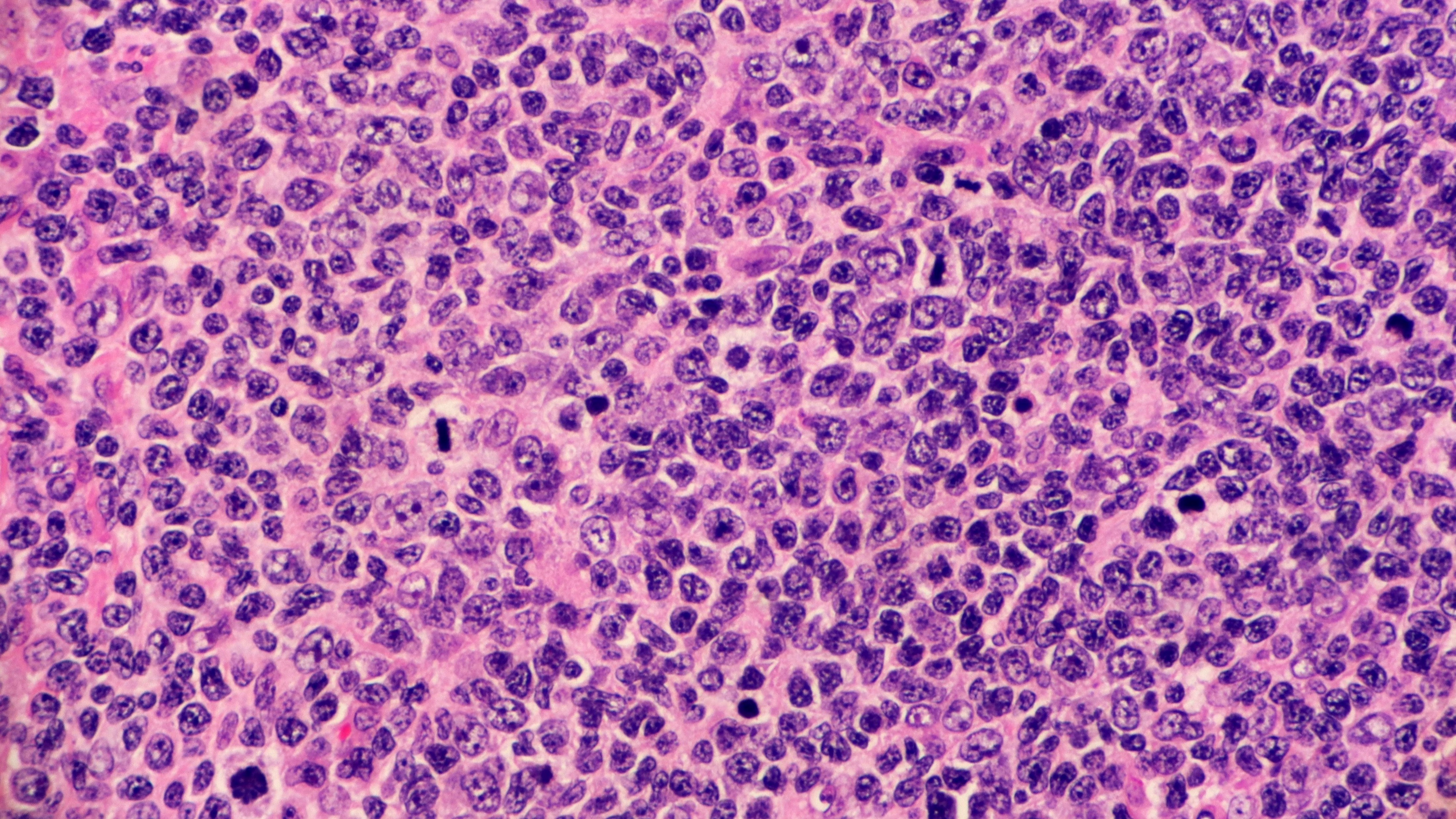 Linfoma folicular R/R: La FDA otorga aprobación acelerada tisagenlecleucel después de dos o más líneas de terapia sistémica, estudio ELARA