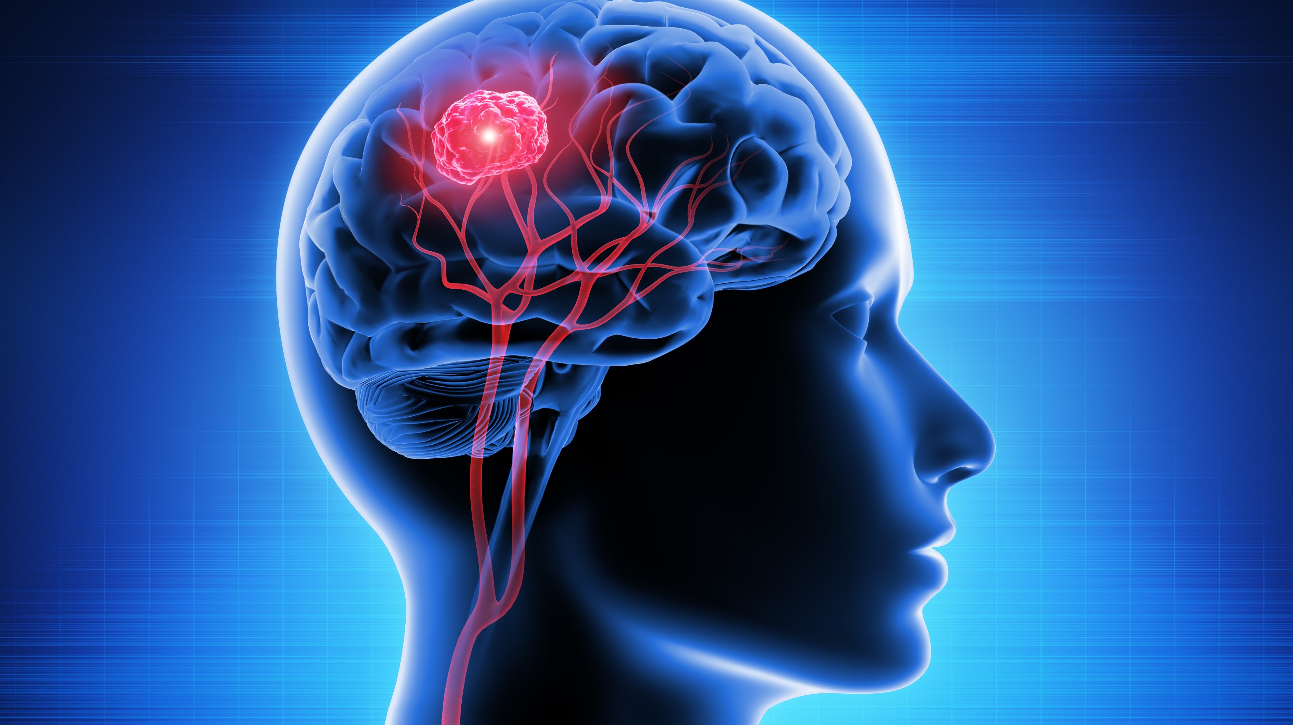 Oligodendrogliomas anaplásicos: QT PCV + RT mejoran la supervivencia, estudio con seguimiento a 20 años