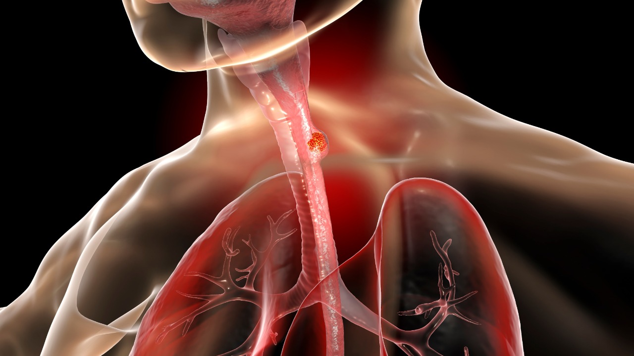 Ca. de esófago avanzado: Tislelizumab + QT mejoraron significativamente la SG en 1L, estudio RATIONALE 306