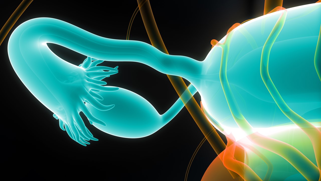 Ca. de ovario resistente al platino: Ofra-vec no mejora la supervivencia de forma estadísticamente significativa, estudio OVAL