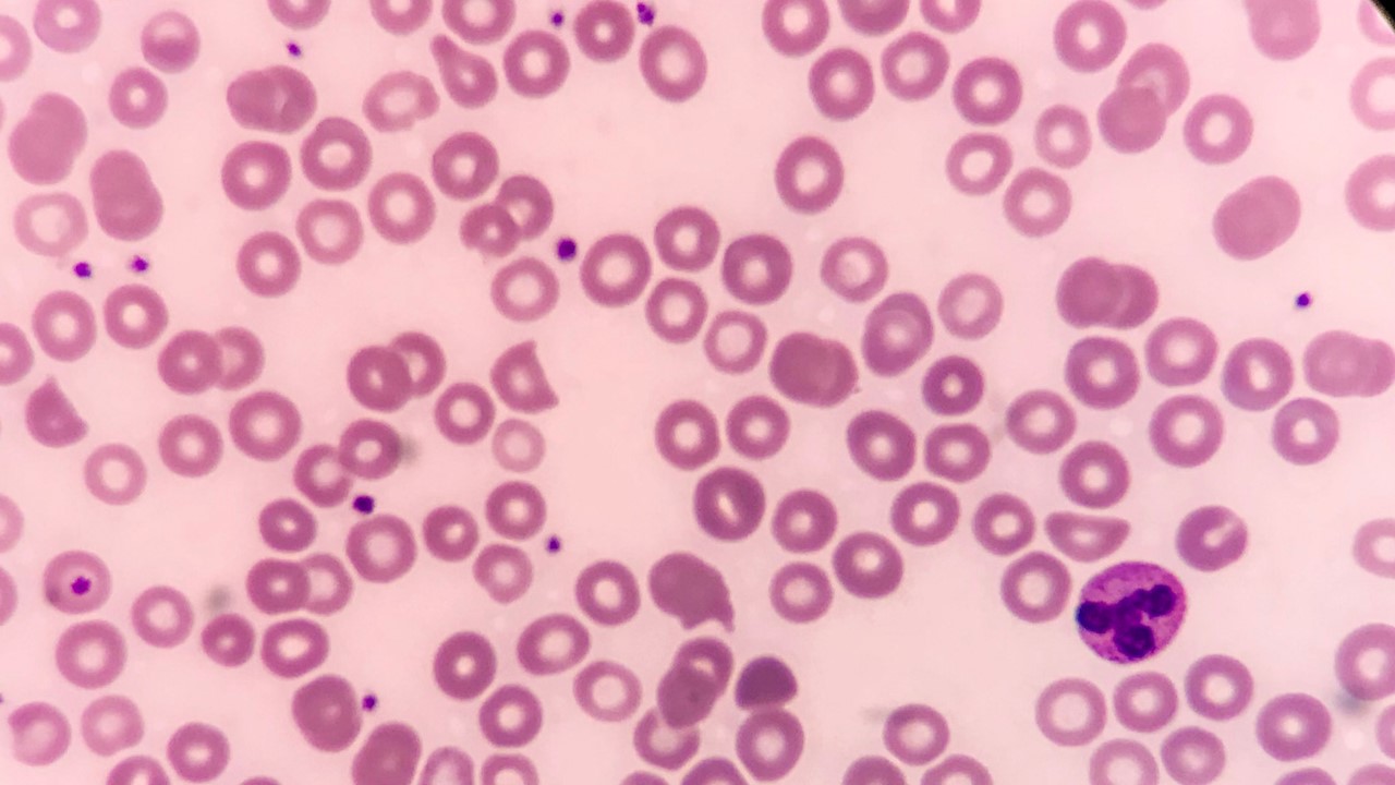 La FDA aprueba eflapegrastim para neutropenia inducida por QT