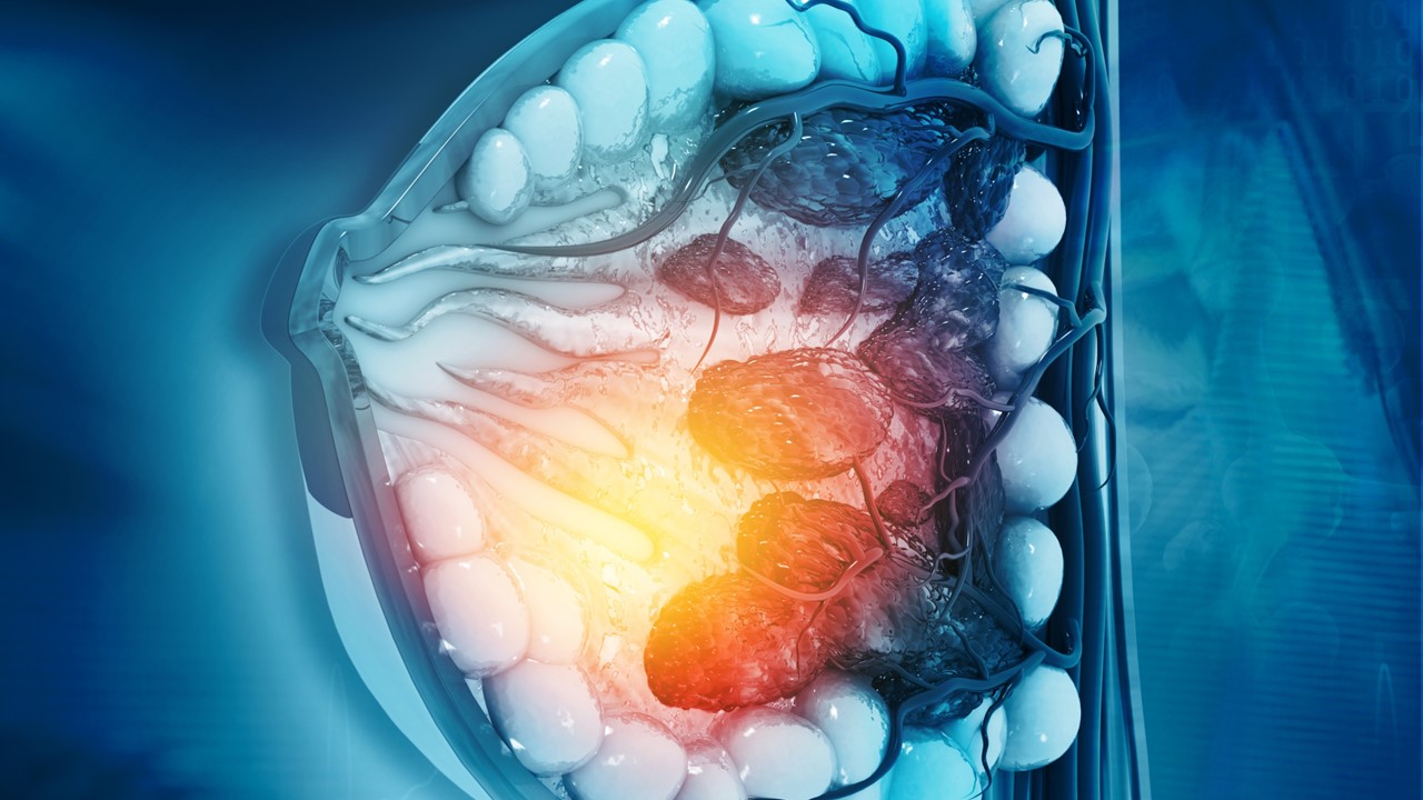 Ca. de mama RH+/HER2 bajo o negativo: Capivasertib + fulvestrant mejoran significativamente la SLP