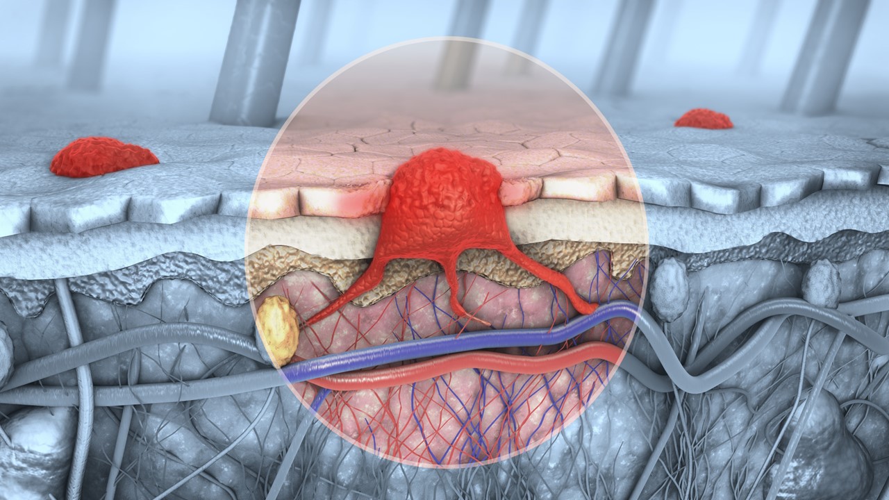 Melanoma IIB o IIC: Nivolumab adyuvante muestra beneficio en SLR vs. placebo, estudio CheckMate-76K