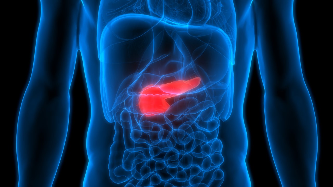 Adenocarcinoma ductal pancreático: Inyección liposomal de irinotecán demostró una mejora estadísticamente significativa en la SG