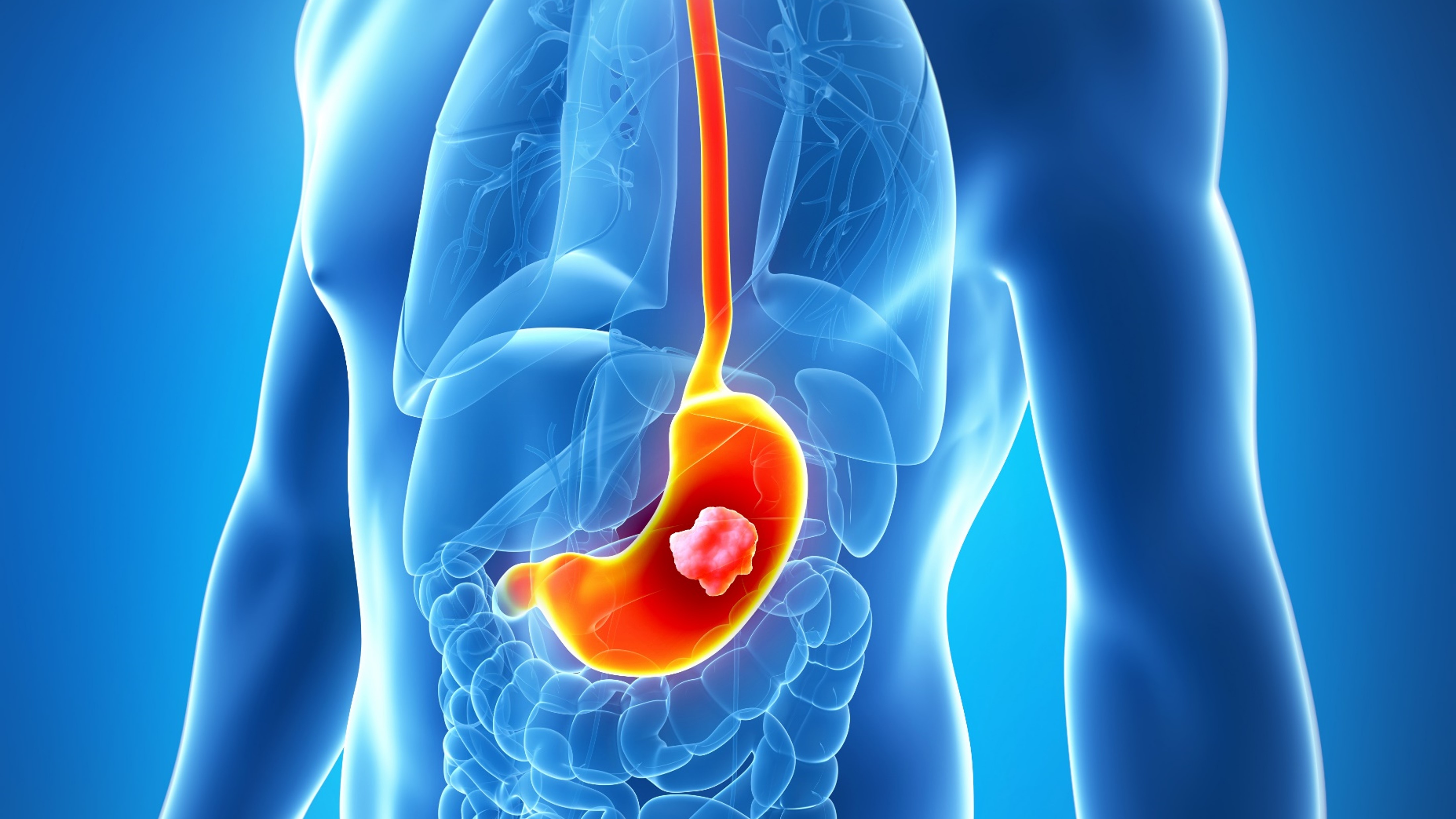 Ca. gástrico o de la unión gastroesofágica: Zolbetuximab + mFOLFOX6 en 1L demuestran mayor supervivencia, estudio SPOTLIGHT