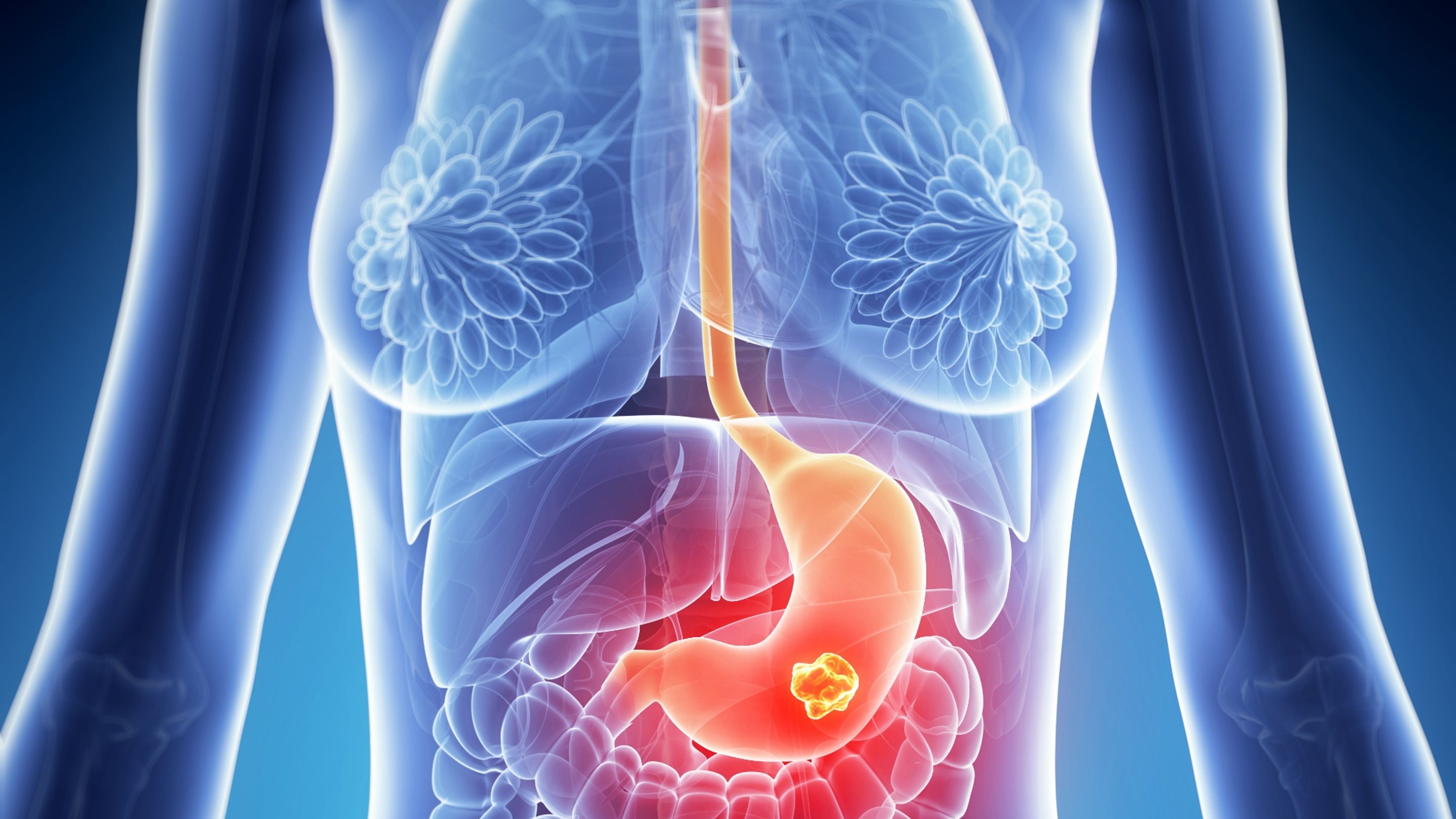 Ca. gastroesofágico y UGE: COFEPRIS aprobó nivolumab adyuvante y en combinación con QT, estudios CheckMate 577 y 649