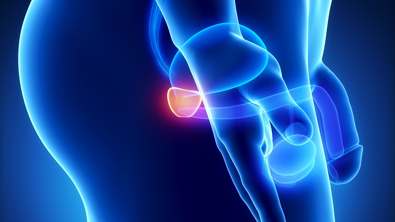 CPRCm: Se mostraron resultados negativos para pembrolizumab + enzalutamida + ADT, estudio KEYNOTE-641