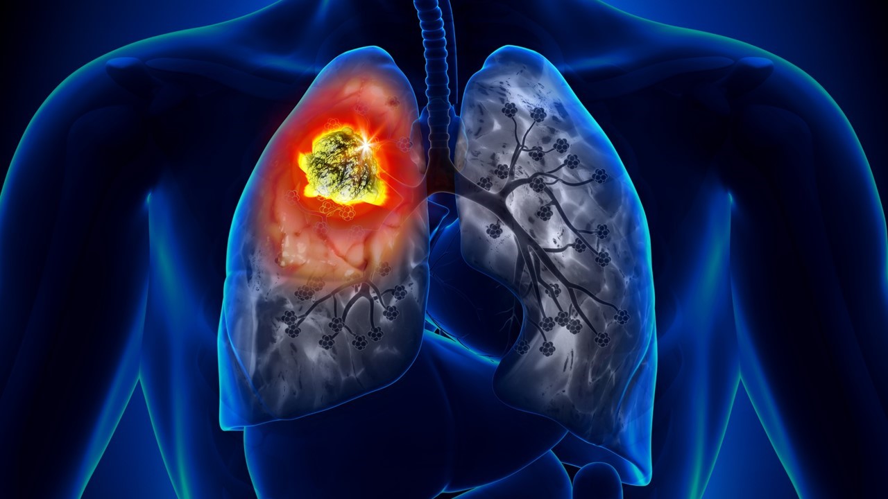 CPCNP: Durvalumab mejora significativamente la SLE, estudio AEGEAN