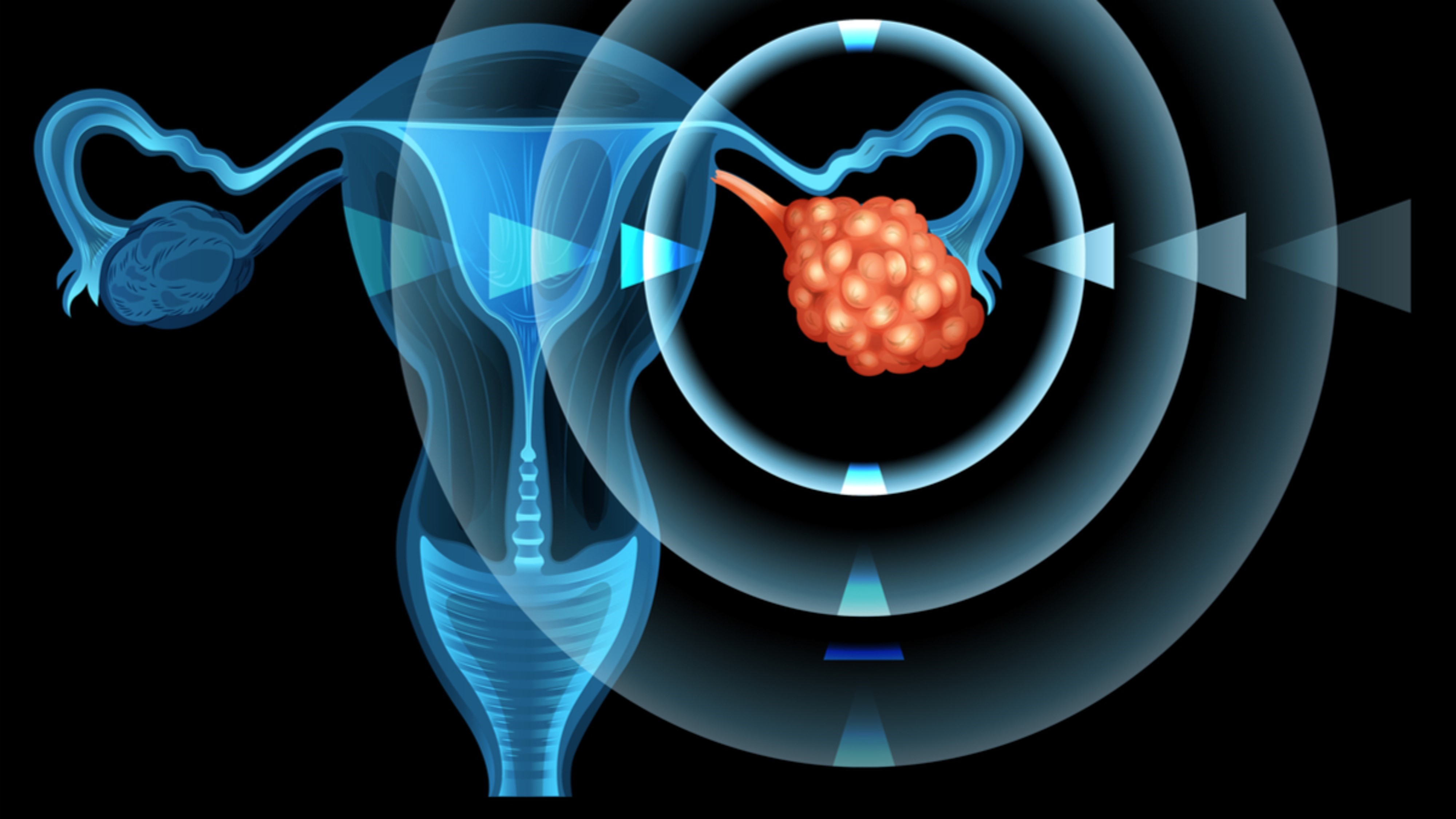 Ca. de ovario avanzado sin mutaciones tumorales BRCA: Resultados positivos de olaparib + durvalumab, estudio DUO-O