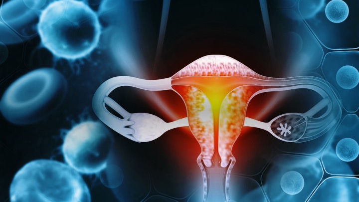 Cáncer de endometrio avanzado: COFEPRIS aprobó lenvatinib + pembrolizumab