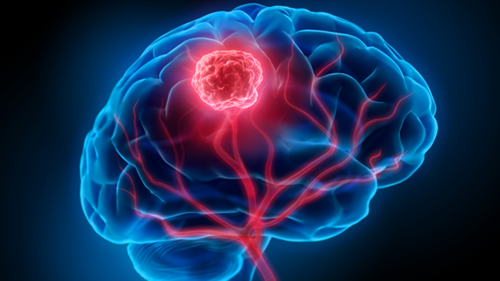 Glioblastoma: NOX-A12 + radioterapia y bevacizumab mejoran la supervivencia, estudio GLORIA