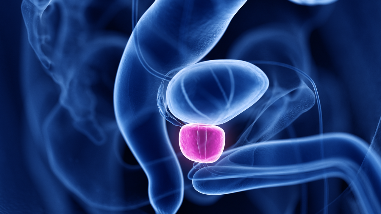 La FDA aprueba olaparib con abiraterona y prednisona/prednisolona para pacientes con CPRCm y BRCAm